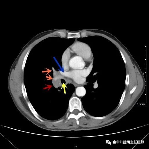 病例分享1小時完成中央型肺癌右全肺切除術