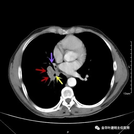 病例分享：1小时完成中央型肺癌右全肺切除术_医学界-助力医生临床决策