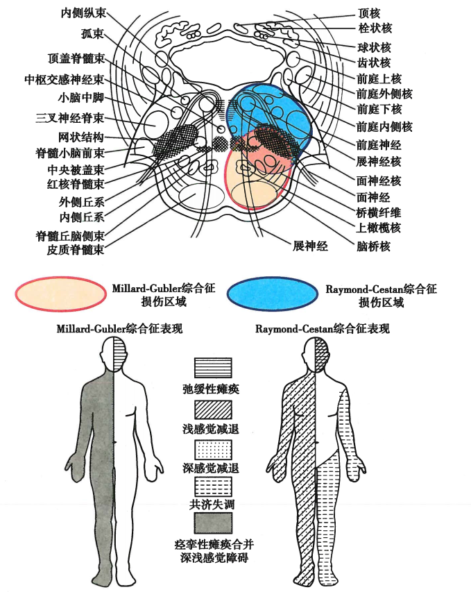 图4 脑桥综合征损伤部位及表现中脑( mesencephalon)(1) 一侧中脑大脑
