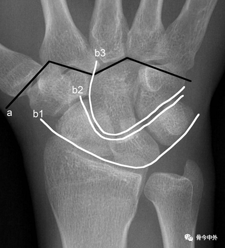 腕关节x线解剖及诊断,这份图谱太实用了