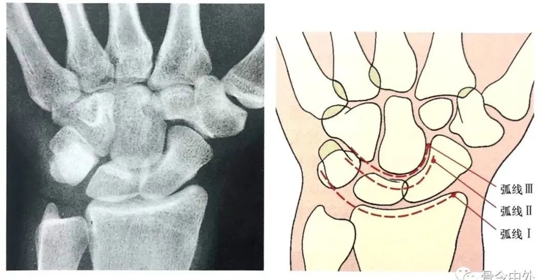 腕关节x线解剖及诊断 这份图谱太实用了 医学界 助力医生临床决策和职业成长