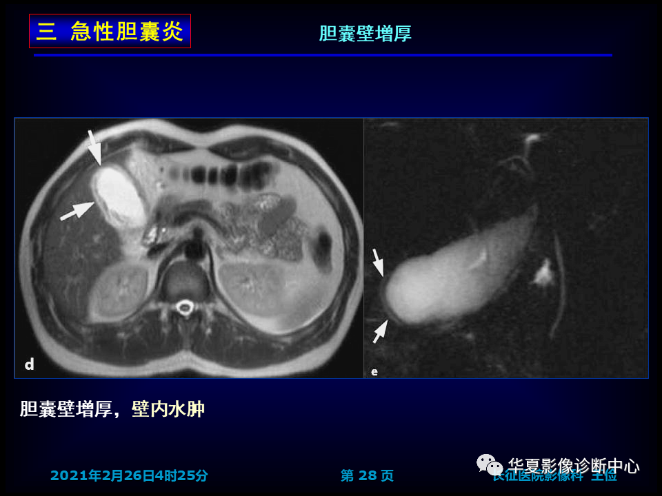 胆囊炎影像诊断
