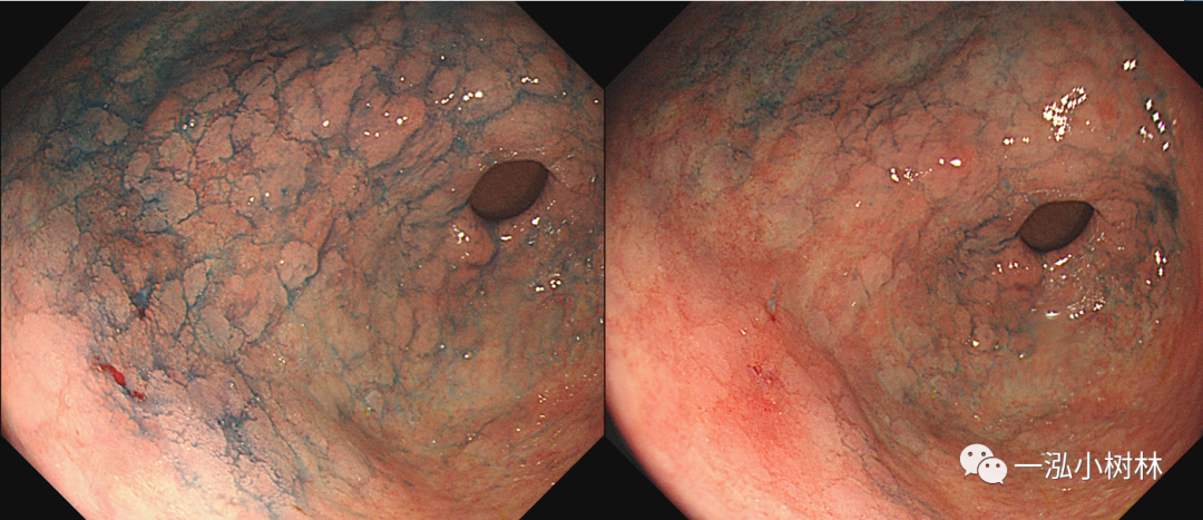 内镜集锦:正常胃结构vs正常十二指肠黏膜结构