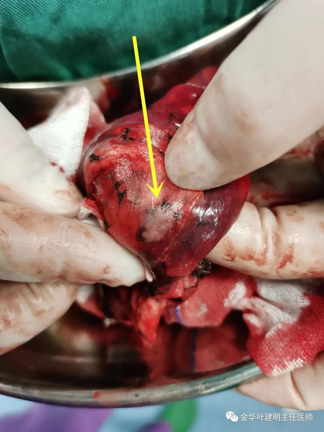 经验积累:平扫ct看肺段之右肺上叶(结合病例讲解)_医学界-助力医生