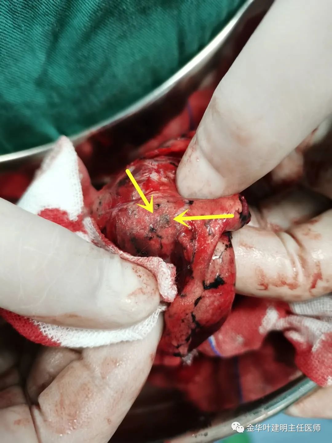 经验积累:平扫ct看肺段之右肺上叶(结合病例讲解)_医学界-助力医生