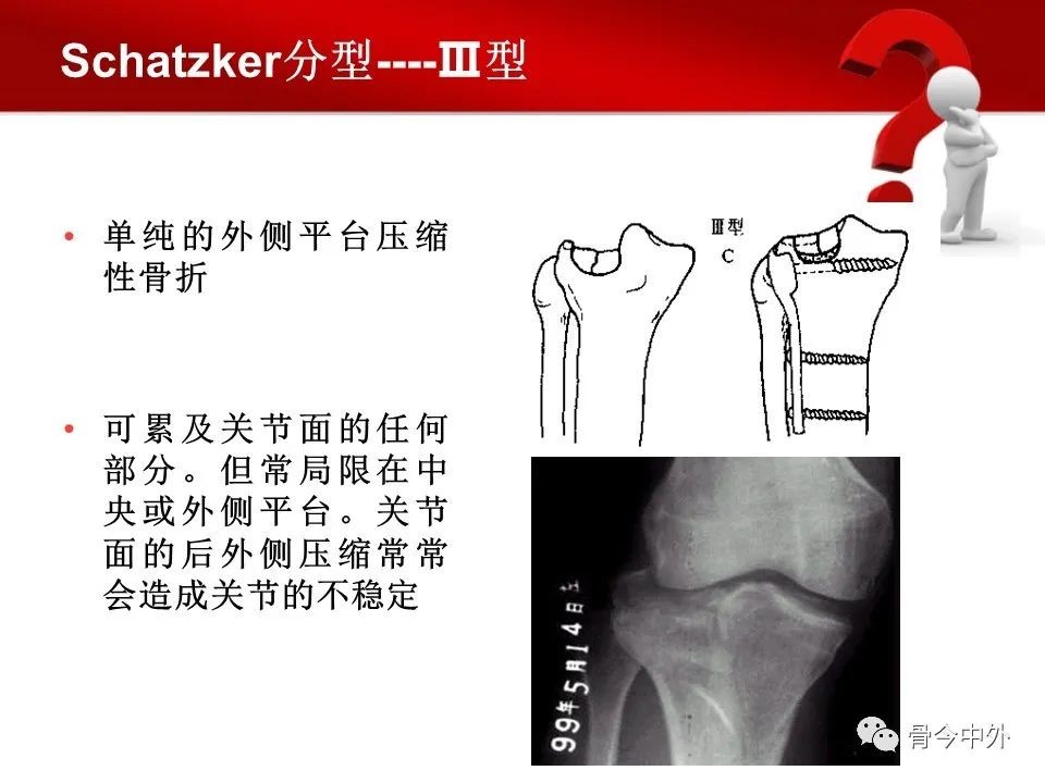 胫骨平台骨折 分型及手术技术 要点详解 医学界 助力医生临床决策和职业成长
