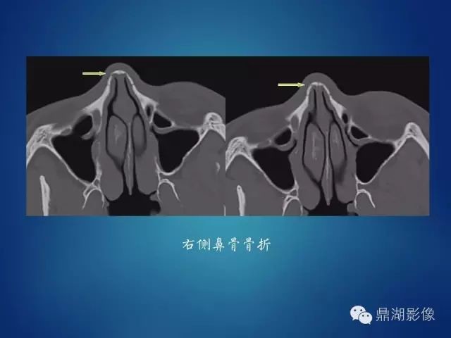 鼻骨骨折影像表现 医学界 助力医生临床决策和职业成长