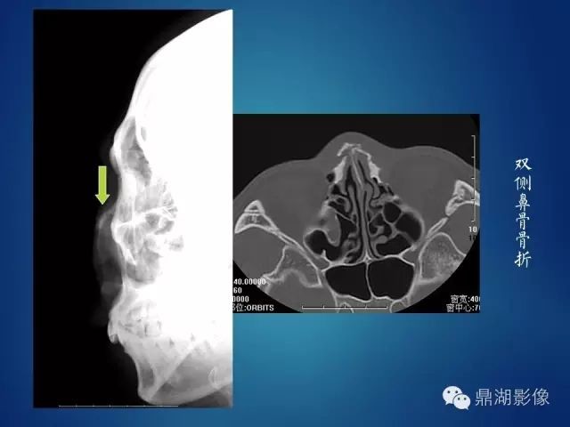 鼻骨骨折影像表现 医学界 助力医生临床决策和职业成长