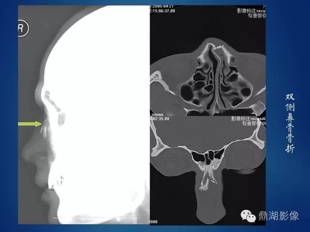 鼻骨骨折影像表现 医学界 助力医生临床决策和职业成长