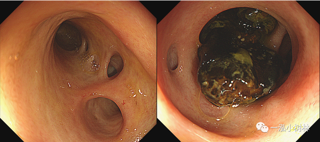 图13:胆肠吻合结石图14:食管下段乳头状瘤白光内镜可见食管下段白色