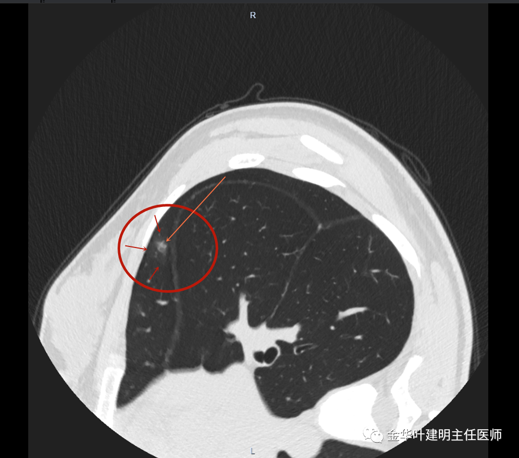 早期肺混合磨玻璃结节复查很重要