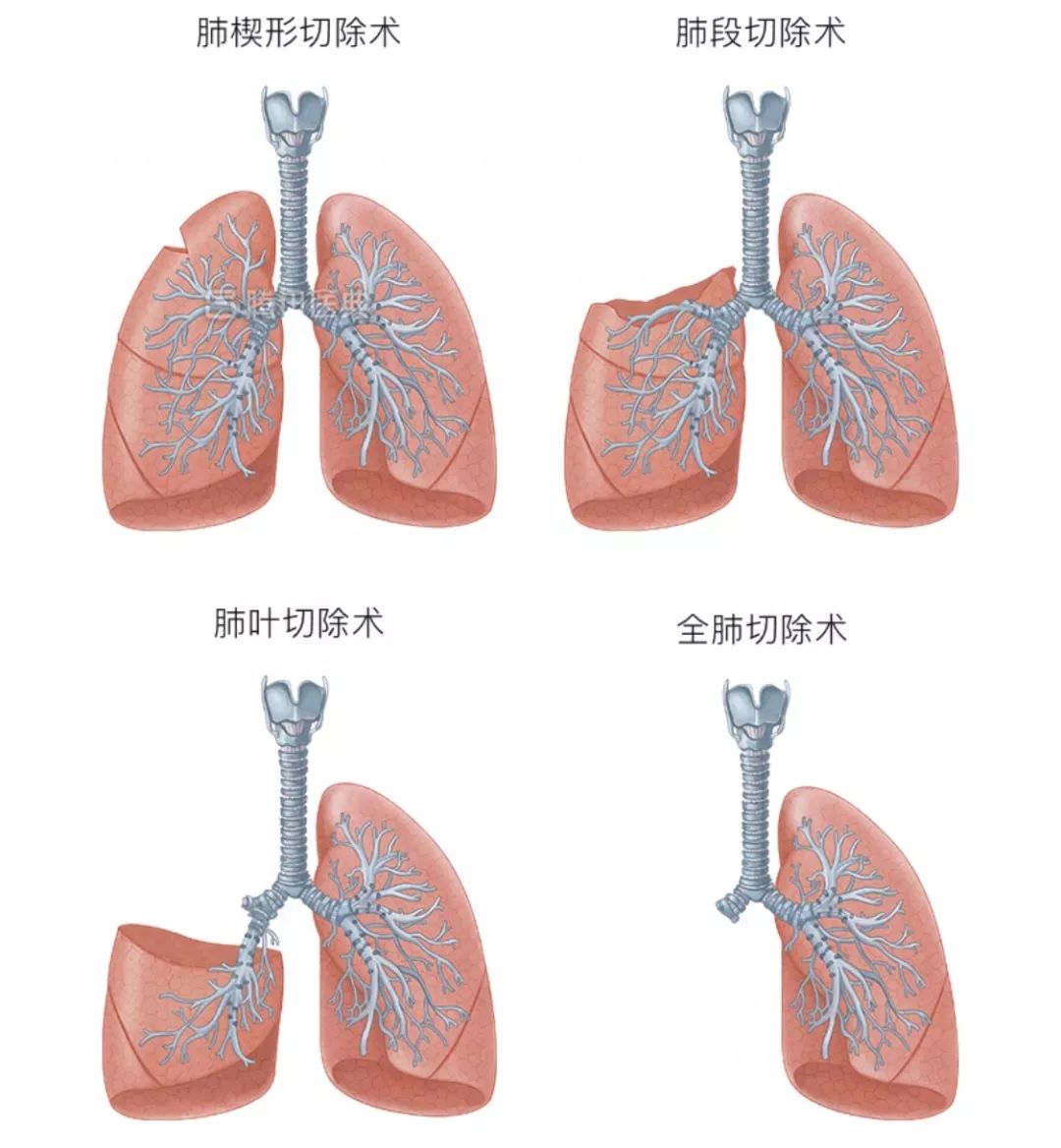 气管癌图片