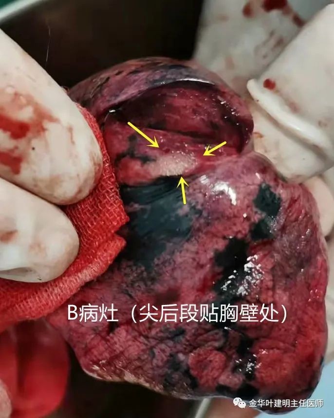 大体标本:至少微浸润性腺癌,不能排除浸润性腺癌的贴壁生长型.