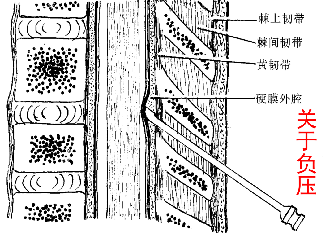 腰麻解剖层次图片图片