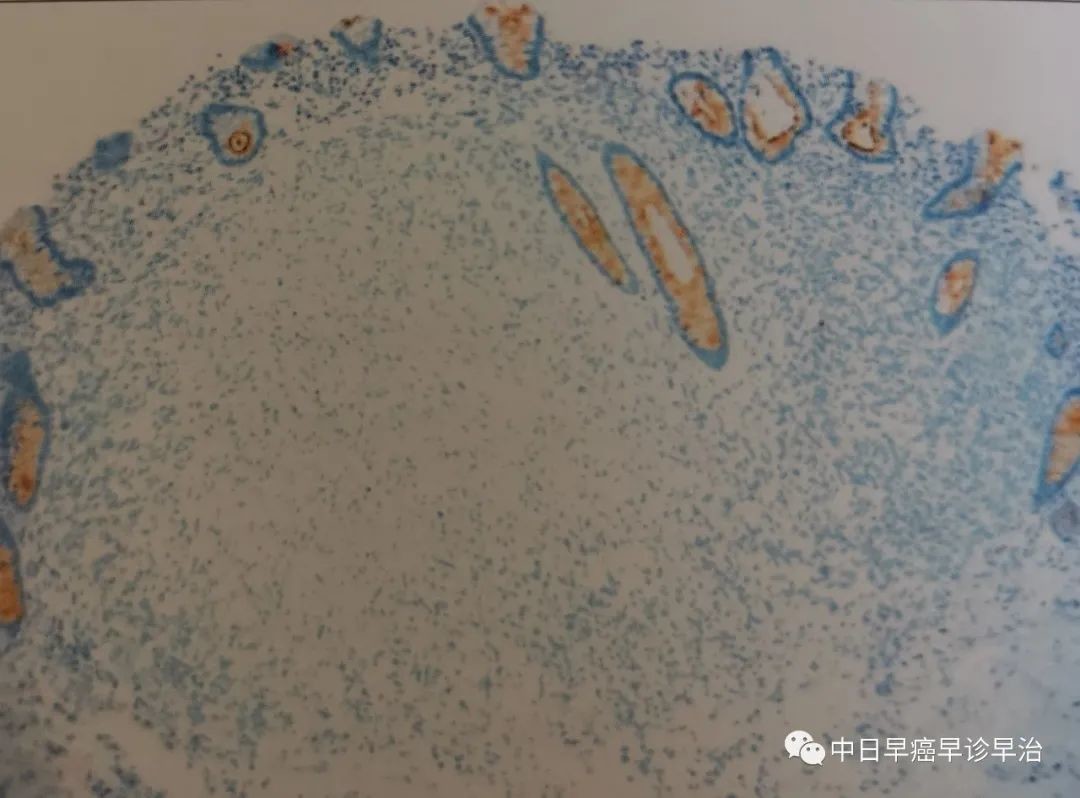 细胞间可见细小的嗜酸性纤维基质大家看看神经束膜瘤的的高倍放大以及