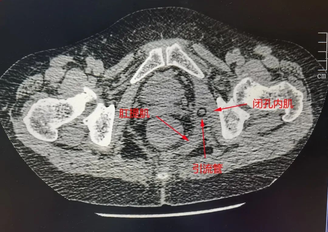 闭孔内肌CT图片