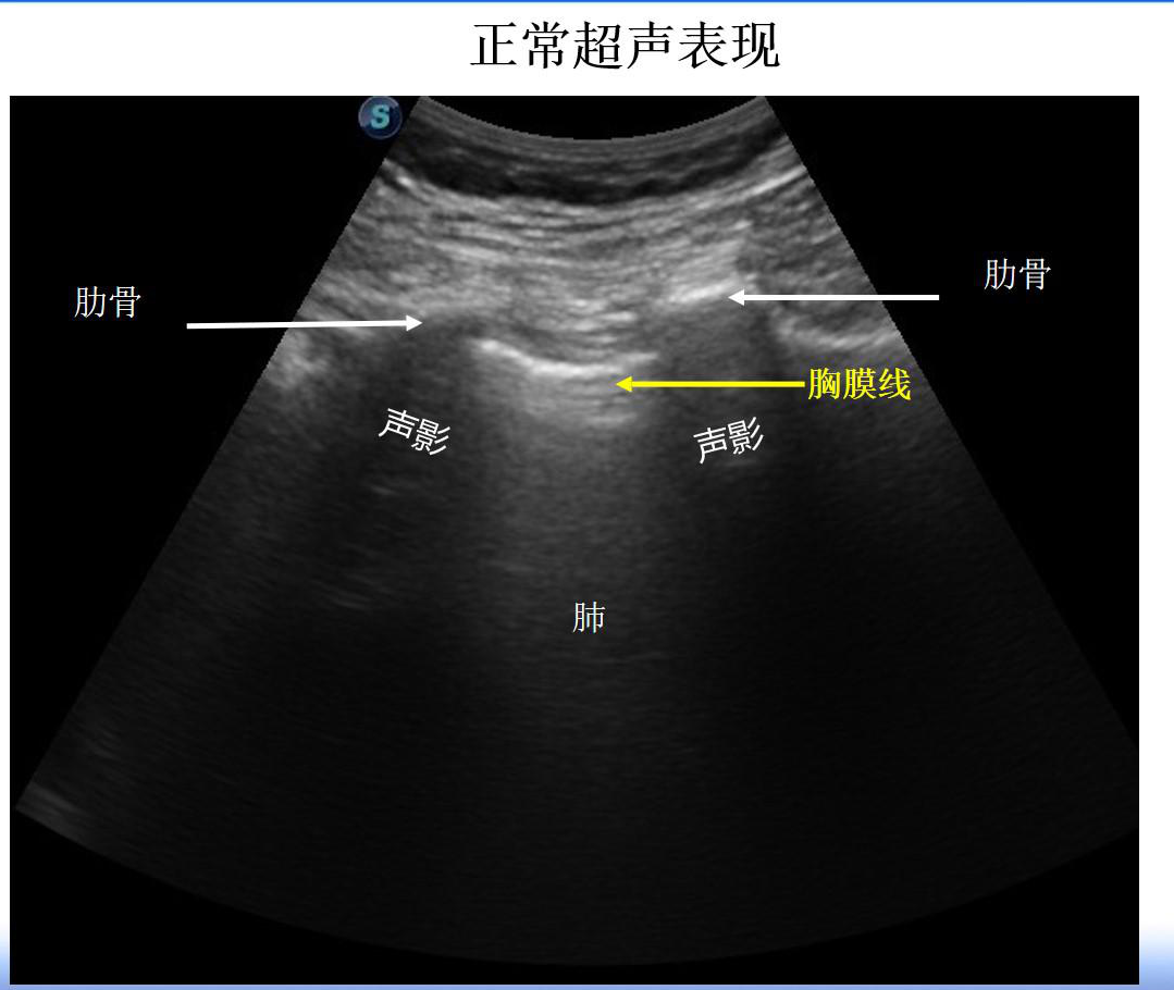 麻醉医生知识扩展 —— 肺部超声_医学界-助力医生临床决策和职业成长