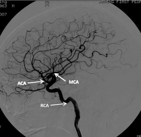 大脑前动脉(aca)是颈内动脉的主要分支之一,是供应大脑半球内侧的主要