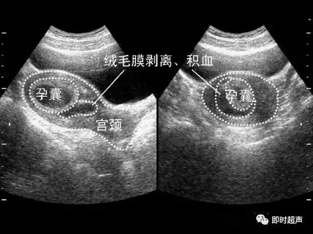 必学 先兆流产 稽留流产 难免流产都有哪些超声征兆 医学界 助力医生临床决策和职业成长