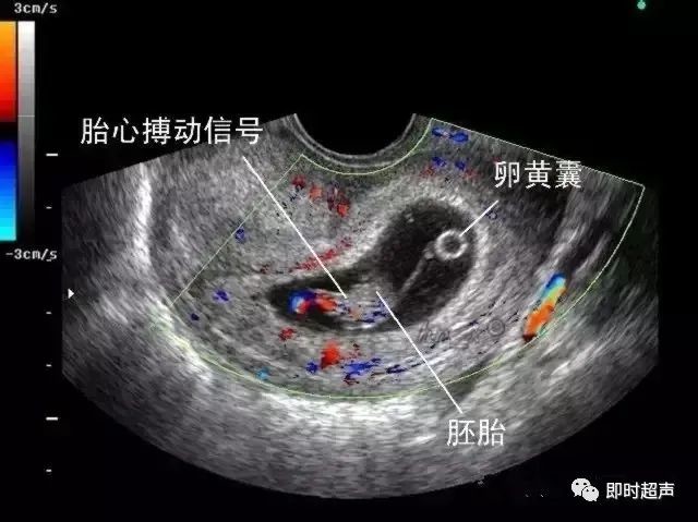必学 先兆流产 稽留流产 难免流产都有哪些超声征兆 医学界 助力医生临床决策和职业成长