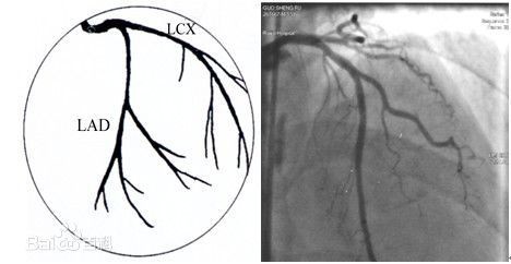 冠状动脉造影没那么难这样教你弄懂
