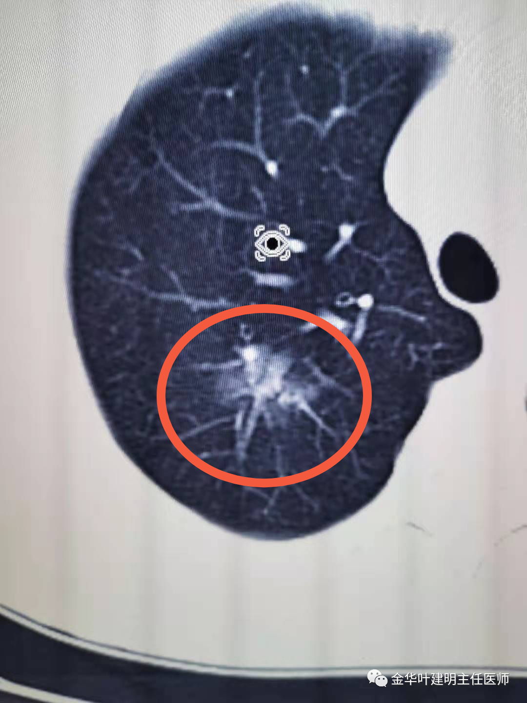 查出肺结节考虑肺癌,医生比患者还着急,却被患者拉黑_医学界-助力医生