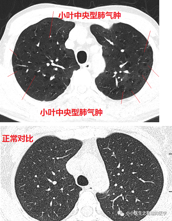 正常的肺和肺气肿图片图片