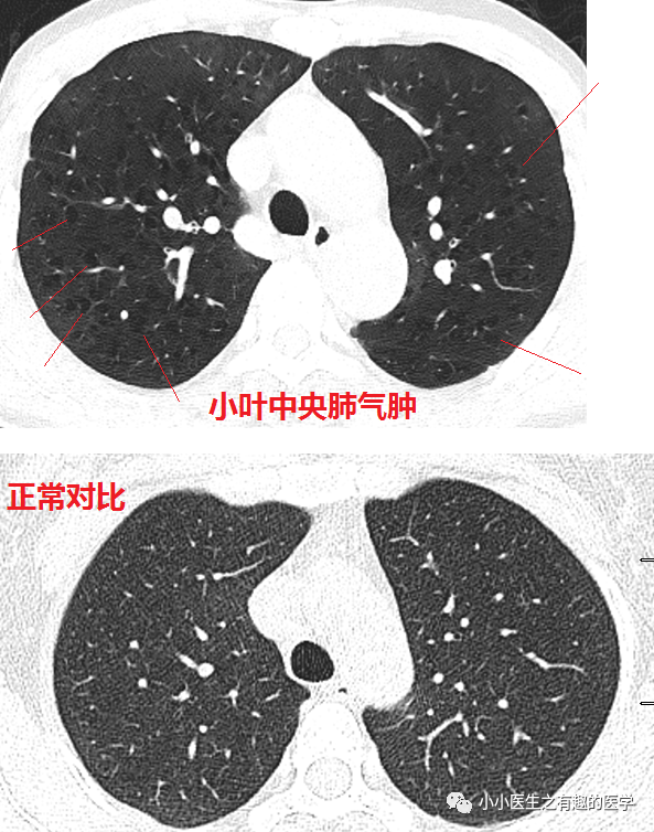 肺部ct图片怎样看懂图片