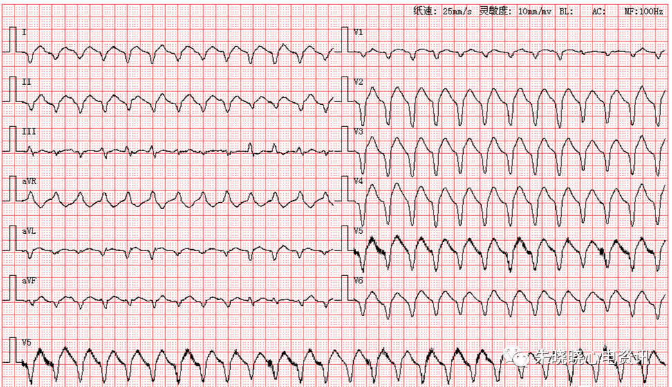 室颤的心电图图片图片