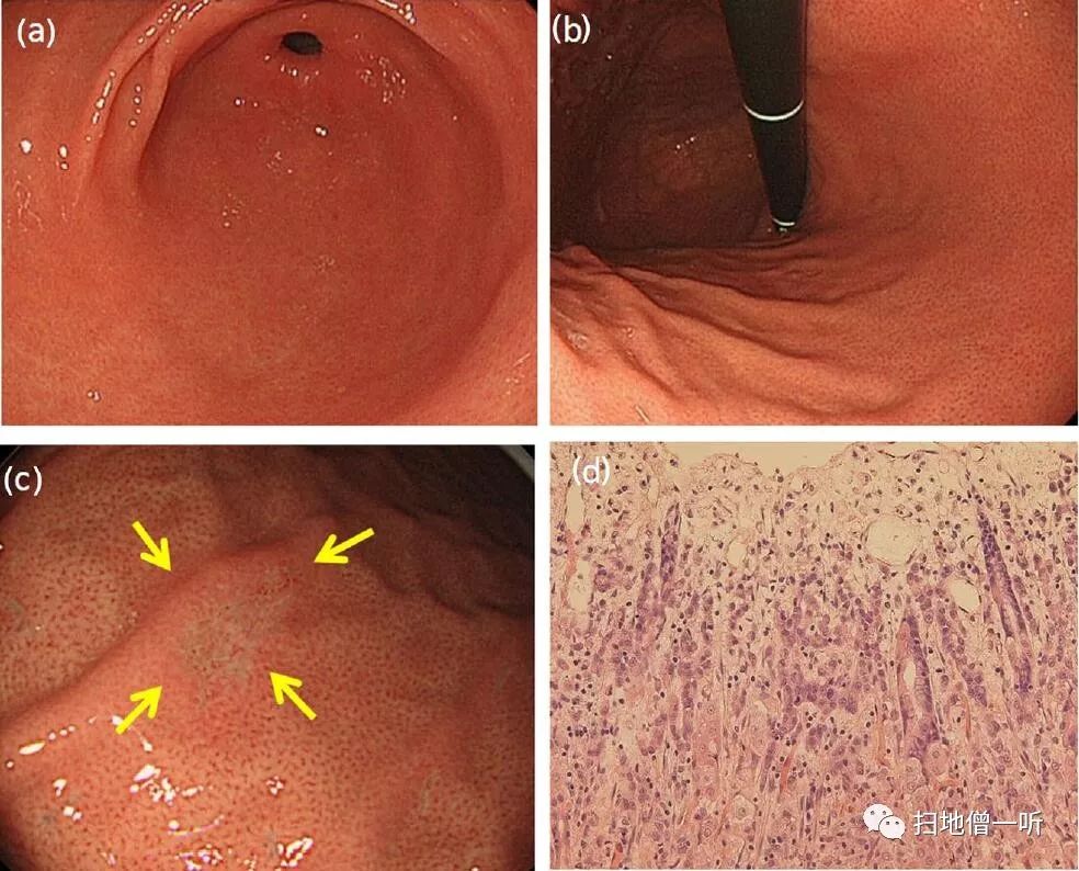 胃癌中期胃镜图片图片