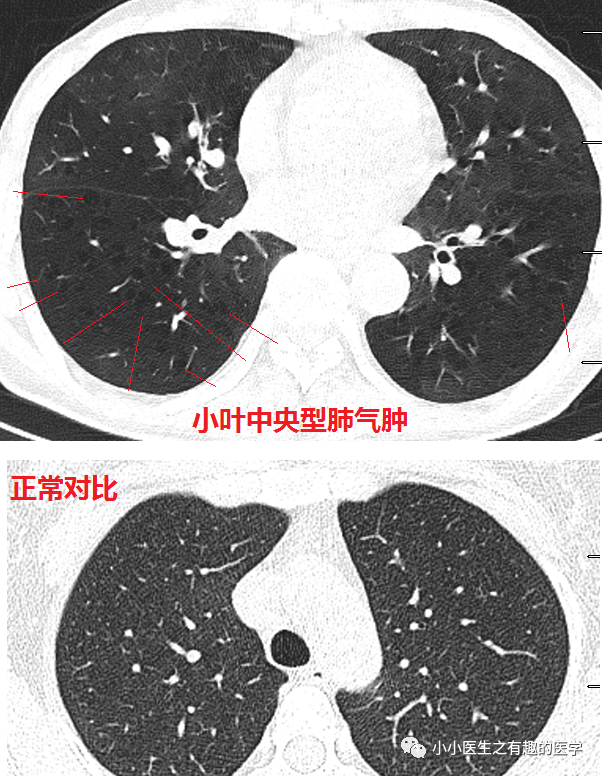 肺气肿胸片图解图片