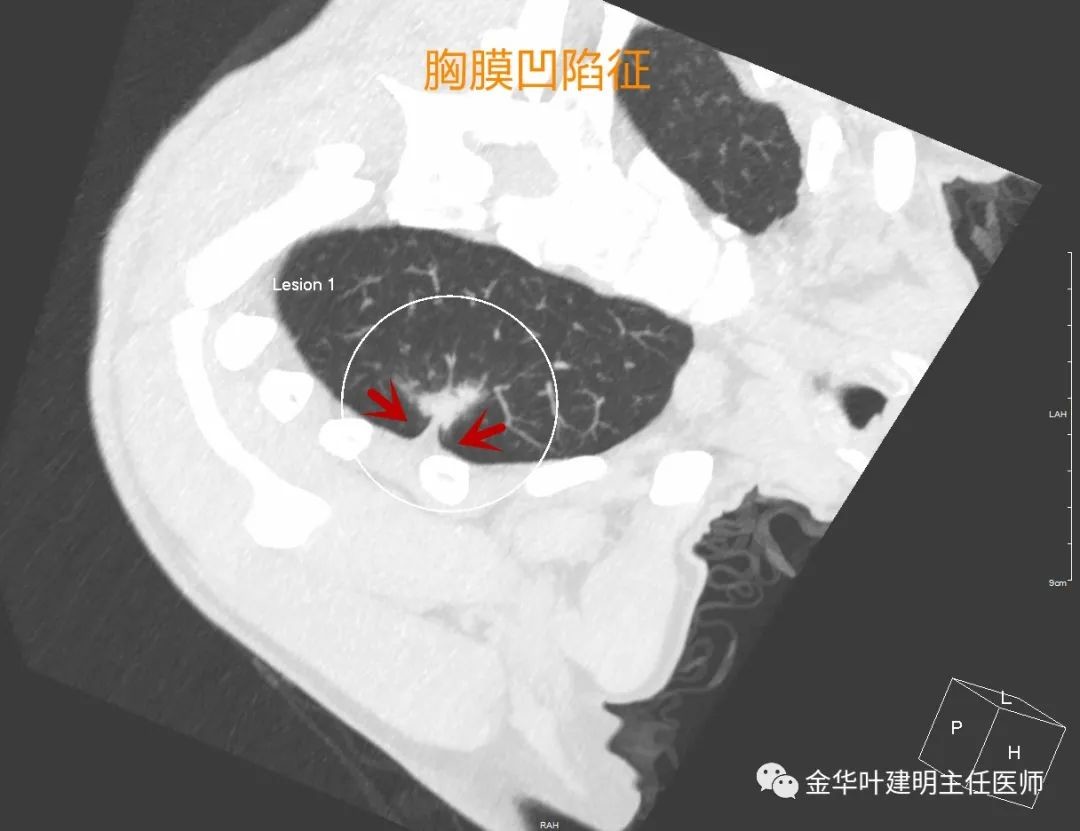 胸膜凹陷征:这是老牌的肺癌恶性征象了,在磨玻璃为表现的早期肺癌中也