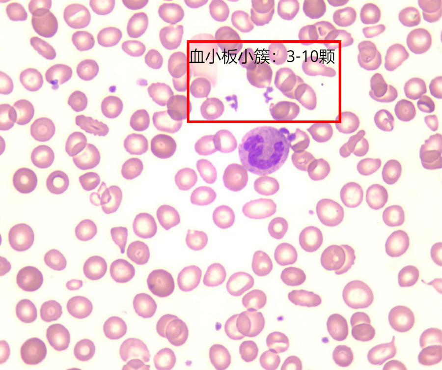 形态学报告中血小板应该如何描述 ?