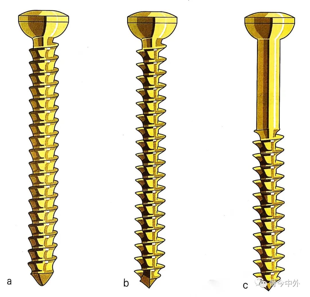 螺钉,接骨板,张力带,详解骨科3大技术!