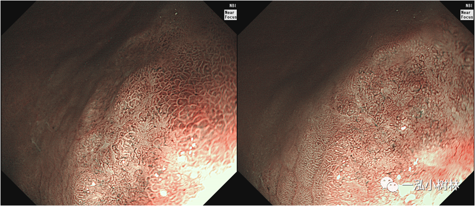内镜集锦:胃多发病变内镜诊断_医学界-助力医生临床决策和职业成长