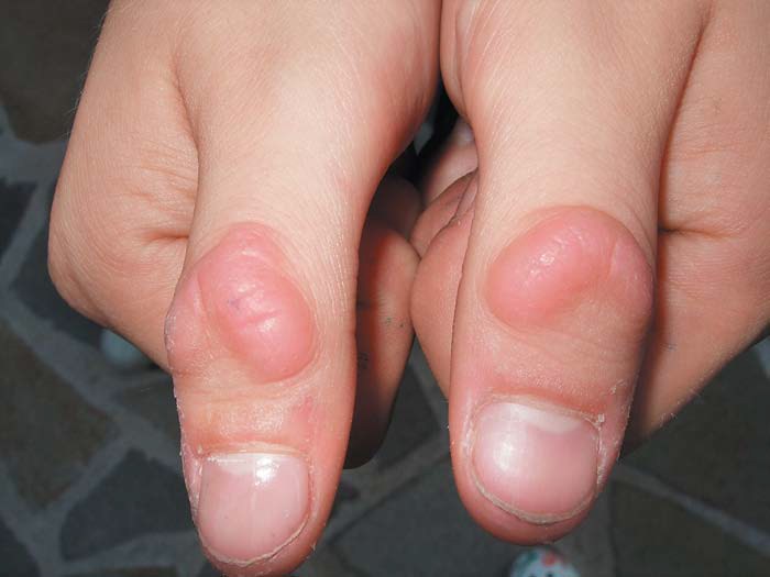 这种皮肤改变,竟然是「咬」出来的?