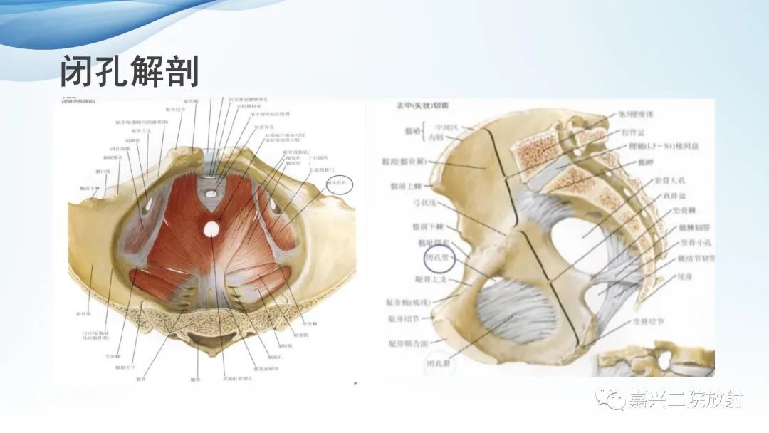 干货总结:闭孔疝ct表现