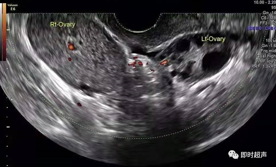 卵巢扭转的超声诊断详细解读——超人必看_医学界-助力医生临床决策和