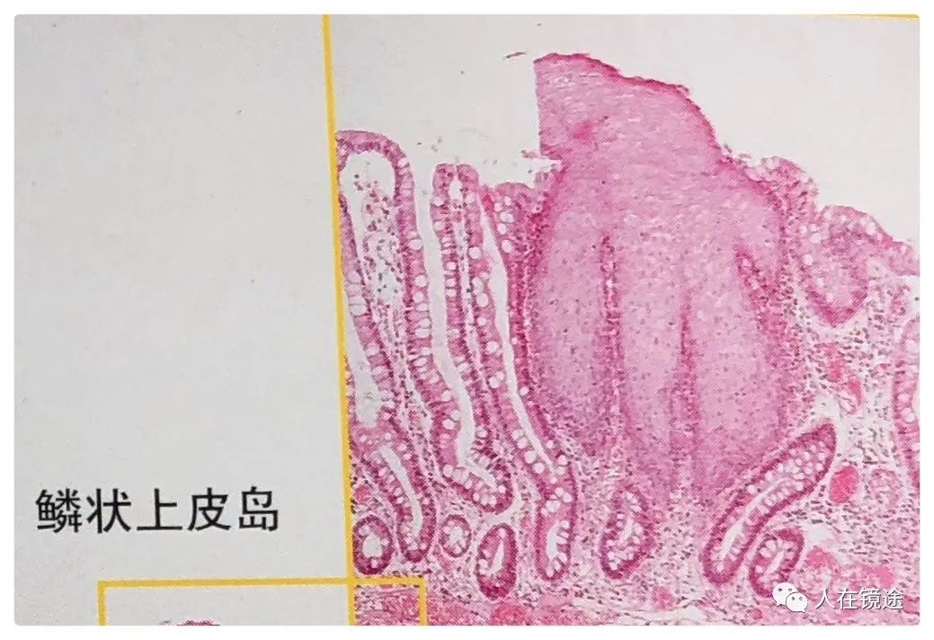 ①鱗状上皮岛:barrett食管的状上皮岛基本上都是与固有食管腺的腺管