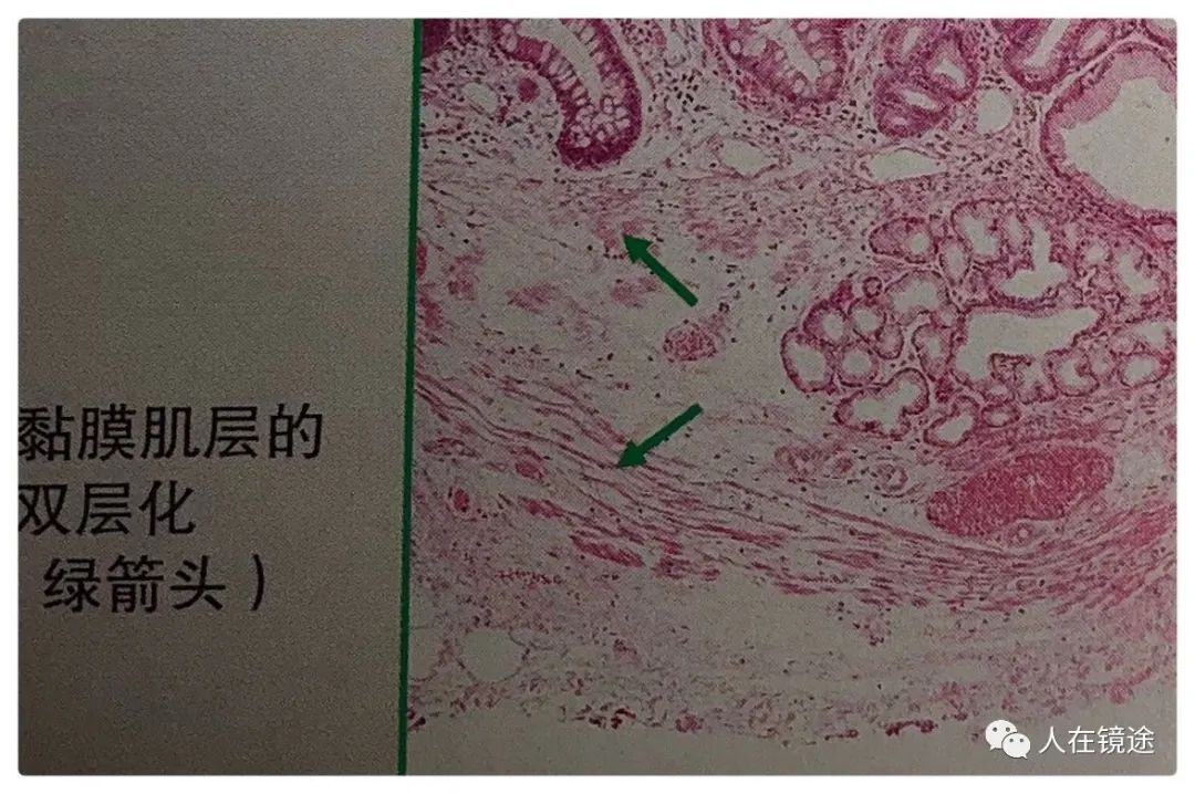 barrett食管早期腺癌的内镜诊断技巧