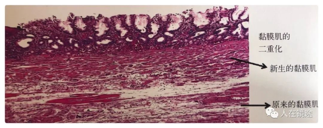 是barrett食管的特征性表现,表层的黏膜肌层(superficial muscularis