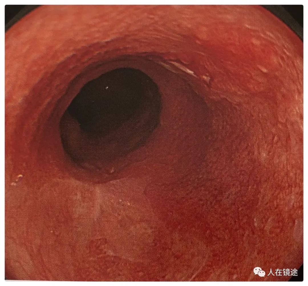 barrett食管早期腺癌的内镜诊断技巧