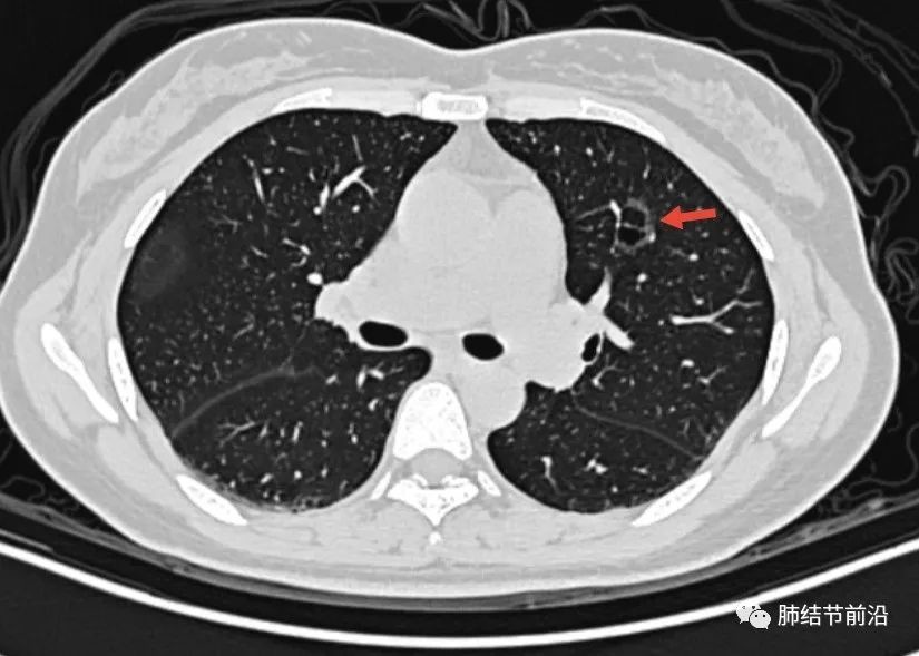極易漏診,囊腔樣肺腺癌的ct特點不能再被忽視了……_醫學界-助力醫生