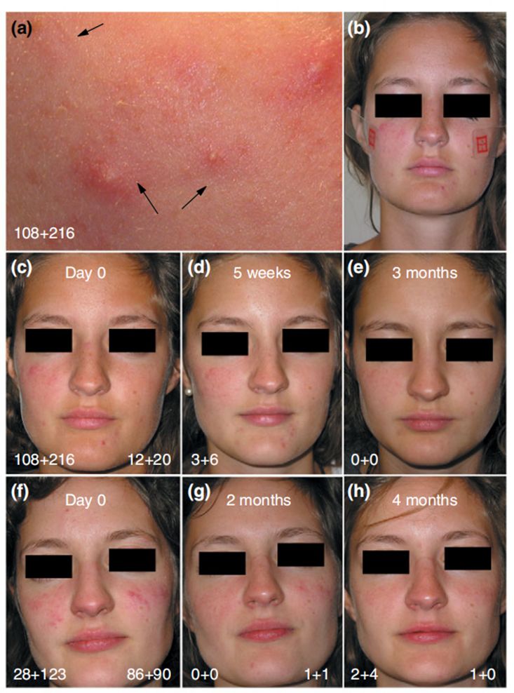丘疹脓疱性玫瑰痤疮与玫瑰痤疮样蠕形螨病或为同一疾病?