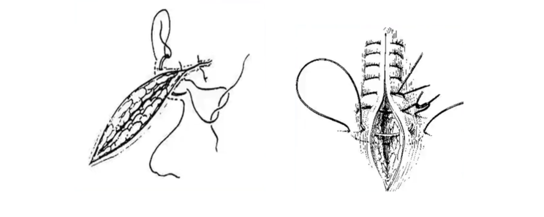 水平外翻缝合法图解图片