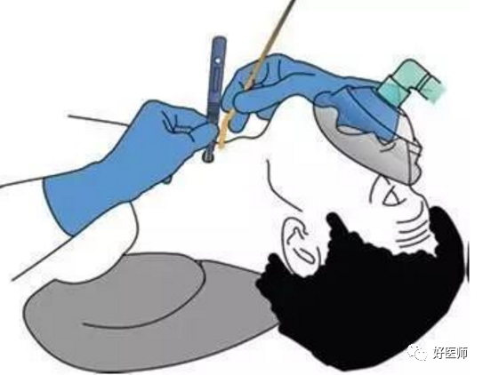 急救技术环甲膜穿刺术