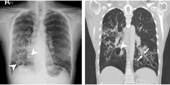 下肺可见增厚的支气管壁相互平行,管径一致,形成典型的双轨征(长箭头)