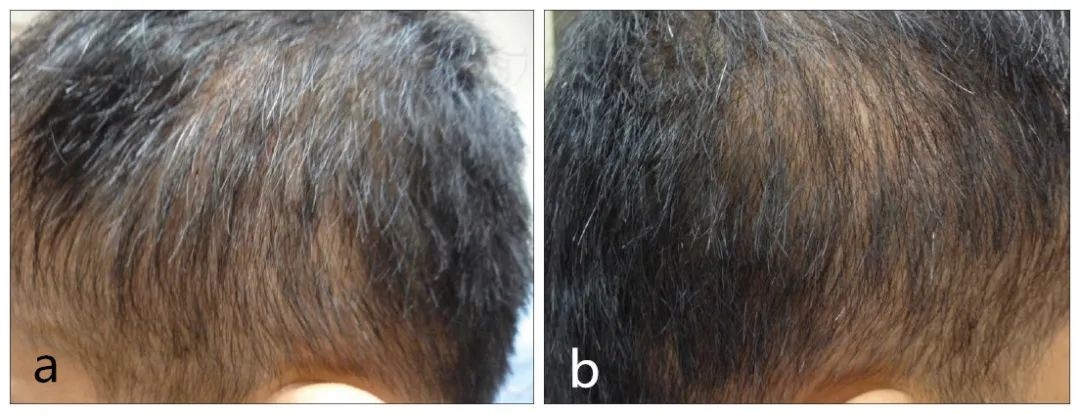 图文盘点,系统疾病相关的继发性脱发_医学界-助力医生临床决策和职业