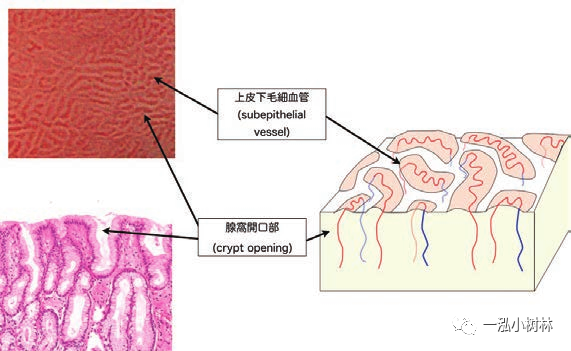 内镜集锦幽门螺杆菌感染内镜下诊断注意点