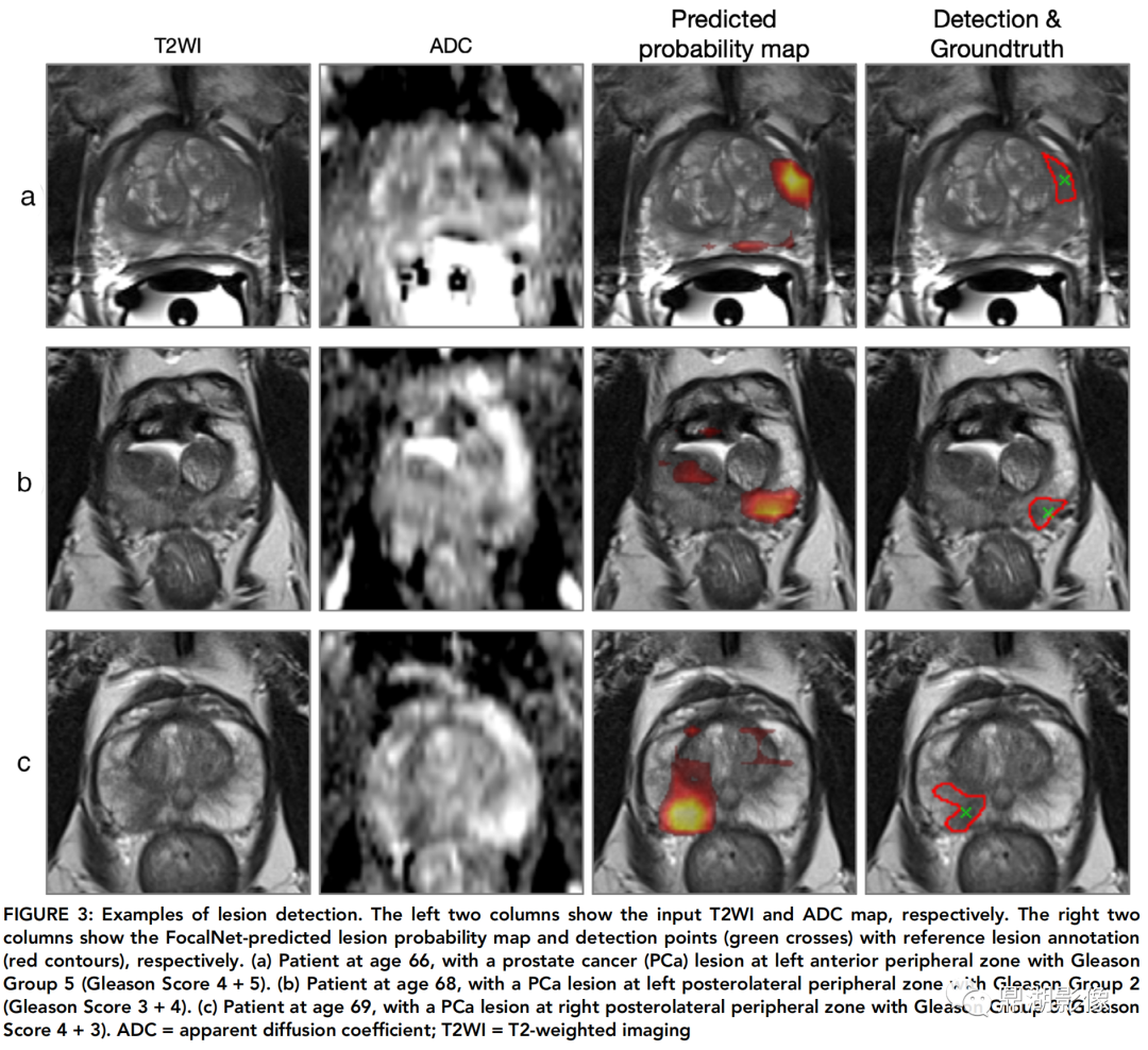 第6节 乳腺癌MRI表现-外科学-医学